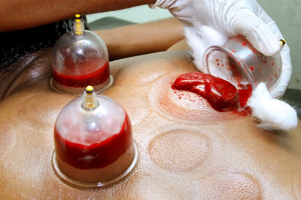 Hijama-Islam-dawntravels.com